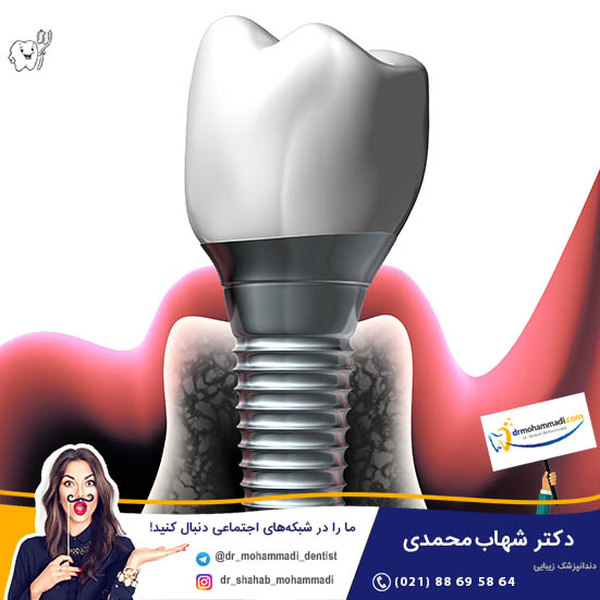 آیا بعد از کاشت ایمپلنت دندان در لثه (قرار دادن فیکسچر)، لثه بخیه زده می شود؟ - کلینیک دندانپزشکی دکتر شهاب محمدی